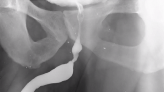 Ağız Mukozası Üretroplasti, Açık Üretra Darlığı Ameliyatı