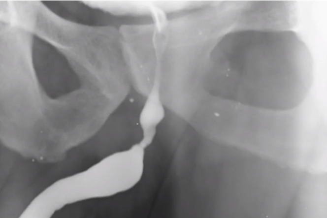 Ağız Mukozası Üretroplasti, Açık Üretra Darlığı Ameliyatı Ağız Mukozası Üretroplasti, Açık Üretra Darlığı Ameliyatı