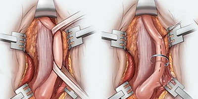 uretrodarlığı-ameliyatı-açık-mı-kapalı-mı