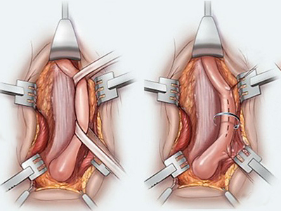 uretrodarlığı-ameliyatı-açık-mı-kapalı-mı