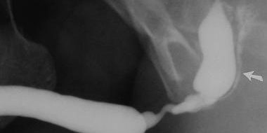 Üretra-Darlığı-Tanısı