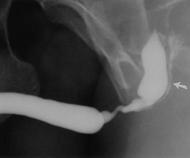 Üretra-Darlığı-Tanısı