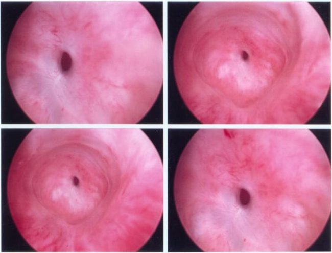 üretra-darlığı-1